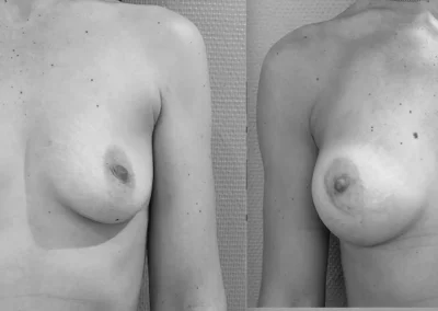 A…36 ans augmentation mammaire par implant anatomique de 360 cc