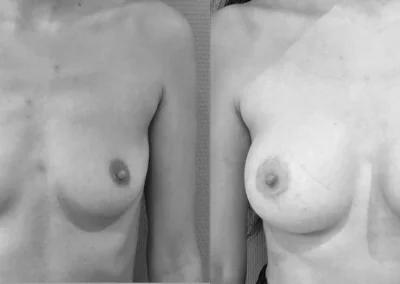H…32 ans Augmentation mammaire par implant anatomique 335 cc