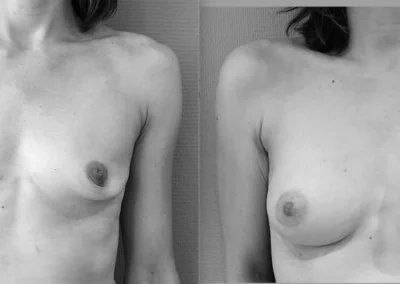 L…39 ans Augmentation mammaire implant anatomique 260 cc