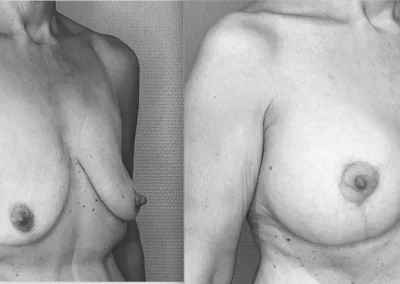 N… 50 ans poitrine tombante et petite traitée par mastopexie (lifting) de la poitrine avec implants de 320 ml