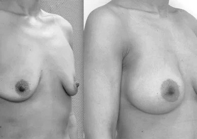 S…38 ans Augmentation mammaire après grossesse  par implant anatomique de 395cc