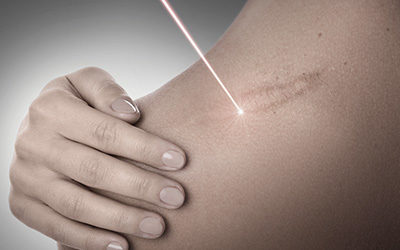 Après la chirurgie esthétique : le laser Urgotouch pour une cicatrice plus esthétique