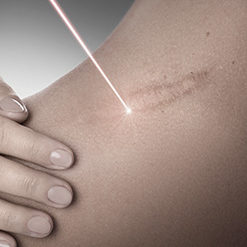 Après la chirurgie esthétique : le laser Urgotouch pour une cicatrice plus esthétique