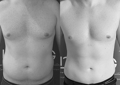 R…33 ans Lipoaspiration Rénuvion® abdomen, flancs, région thoraco-mammaire
