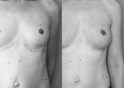 B…44 ans Augmentation mammaire par lipomodelage – Préop 85B- – Postop 85B+