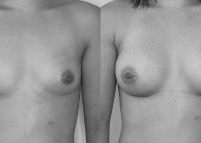 S…28 ans Augmentation mammaire par implant – Préop 80A – Postop 80C