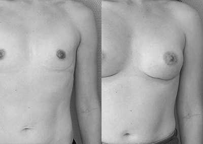 P…34 ans Augmentation mammaire par implant – Préop 85A- Postop 85B+