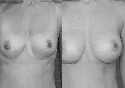J…37 ans Augmentation mammaire par implant – Préop 85B – Postop 85C