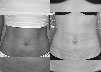 F…40ans Lipoaspiration Rénuvion® sous ombilical