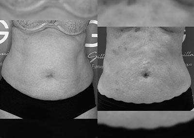 S…60ans Lipoaspiration Vaser Rénuvion® abdomen, flancs