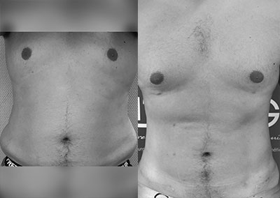 B…28 ans Lipoaspiration Rénuvion® abdomen, flancs, région thoraco-mammaire