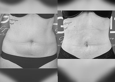C…41 ans Lipoaspiration Rénuvion® abdomen, flancs, dos