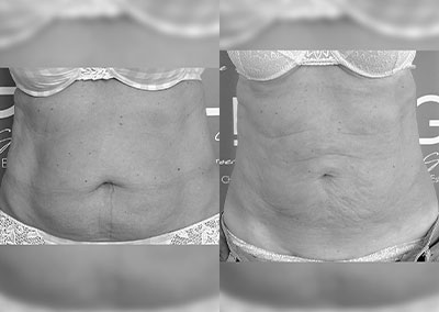 F…65 ans Lipoaspiration Rénuvion® abdomen, flancs