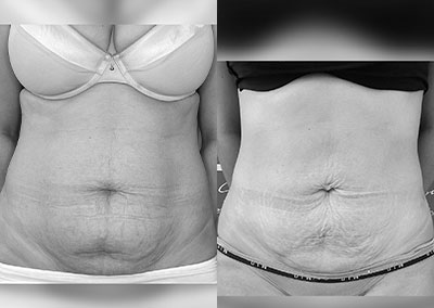 S…27 ans Lipoaspiration Rénuvion® ventre, abdomen, flancs