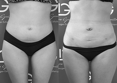 J…31 ans Lipoaspiration Rénuvion® abdomen, flancs