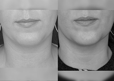 G…25 ans Lipoaspiration Rénuvion® double menton