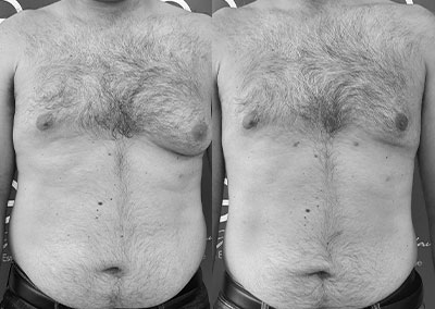 G…55 ans Lipoaspiration Rénuvion® abdomen, adopomastie