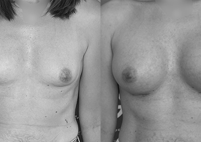 J…32 ans Augmentation mammaire par implant – Préop 90B – Postop 90C