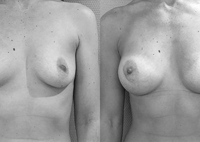 M…35 ans Augmentation mammaire par implant – Préop 90A – Postop 90C