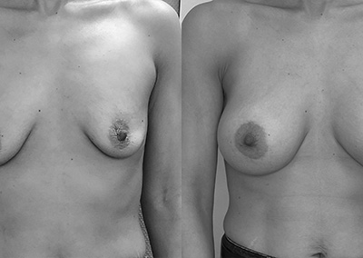 R…37 ans Augmentation mammaire par implant – Préop 90A – Postop 90C