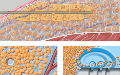 Pourquoi je recommande d’avoir recours aux technologies VASER® et RENUVION ® pour votre lipoaspiration ?